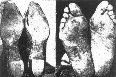 Efectos del calzado en los pies