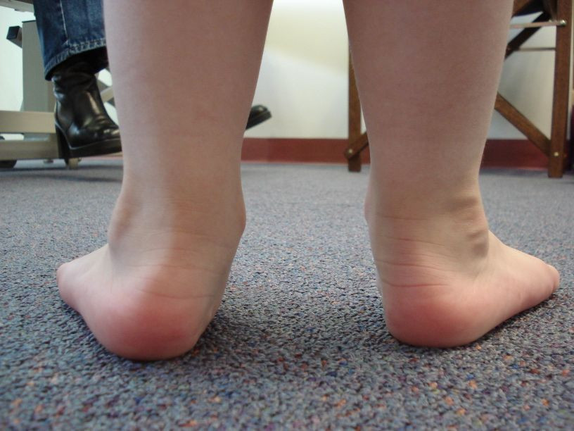 children-flat-feet-by-FA-RenLis-in-wikimedia-CC-BY-SA-3.0.jpg